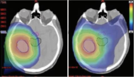 proton therapy for brain tumors versus photon radiation