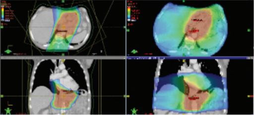 proton therapy for esophageal cancer versus photon radiation