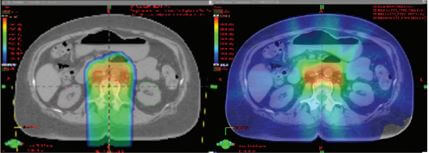 proton therapy for gynecologic cancer versus photon radiation