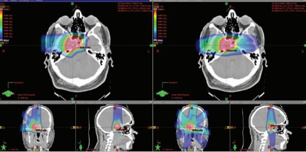 proton therapy for skull base tumor versus photon radiation