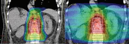 proton therapy for spinal tumors versus photon radiation
